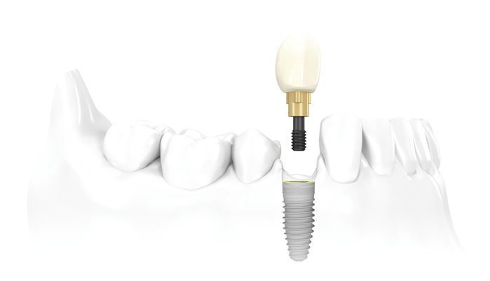 implant-dentar