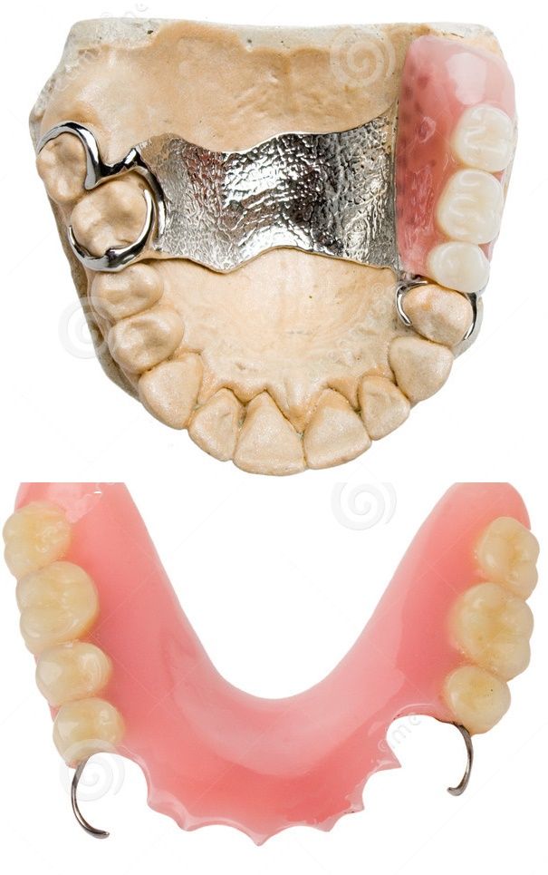 proteza dentara scheletata