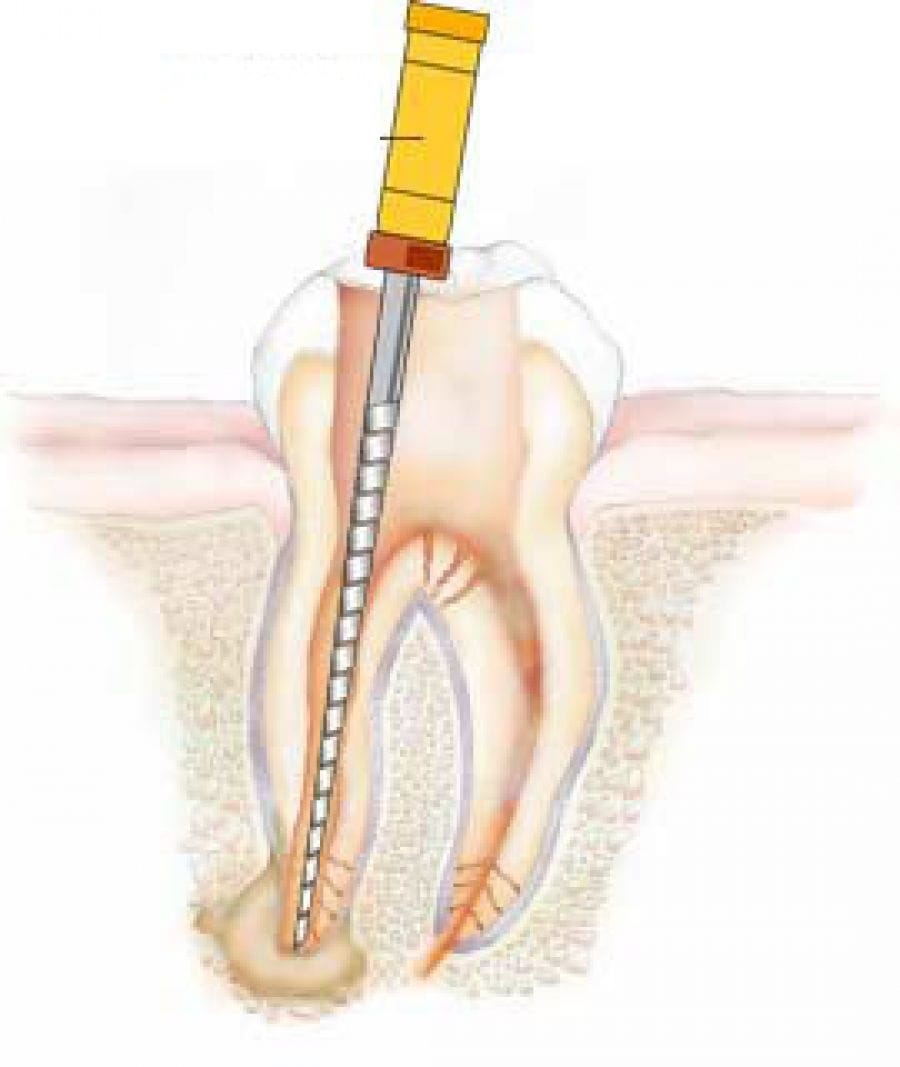 Misuse tool Grace endodontie - Office Dent - clinica stomatologie Ploiesti
